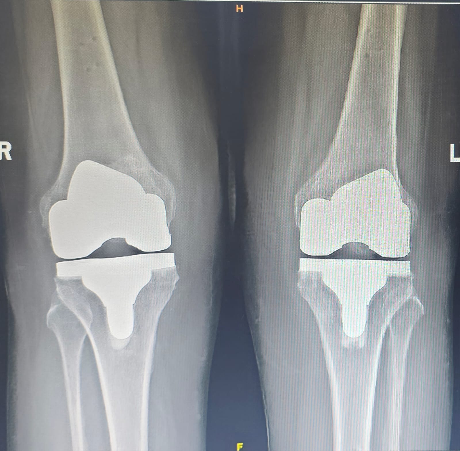 After hip fracture fixation X-ray with plate and screws